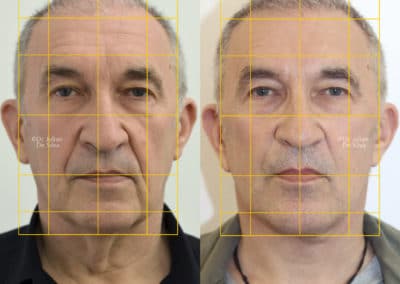 Facelift in London Before & After Results