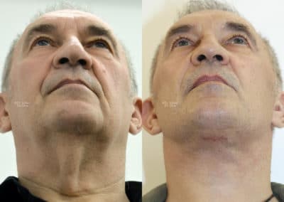 Facelift in London Before & After Results