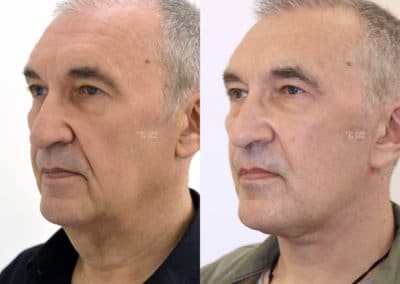 Facelift in London Before & After Results