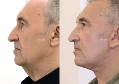 Facelift in London Before & After Results