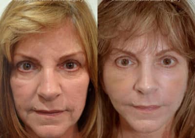 Facelift in London Before & After Results