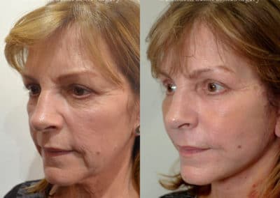 Facelift in London Before & After Results