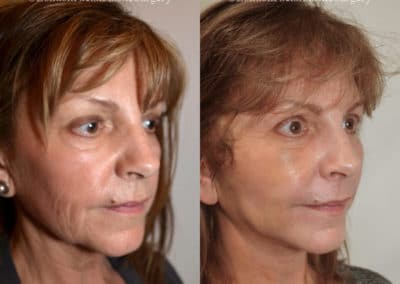 Facelift in London Before & After Results