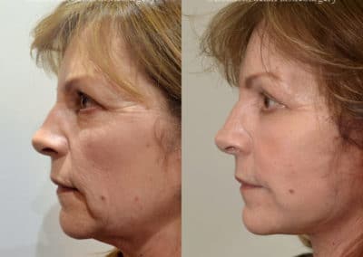 Facelift in London Before & After Results