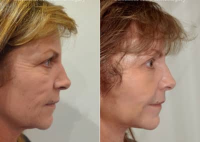 Facelift in London Before & After Results