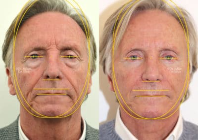 Facelift in London Before & After Results