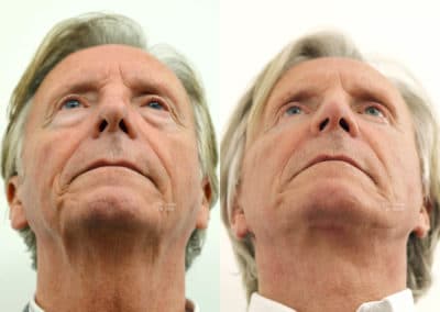 Facelift in London Before & After Results