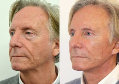 Facelift in London Before & After Results