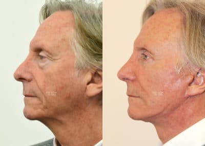 Facelift in London Before & After Results