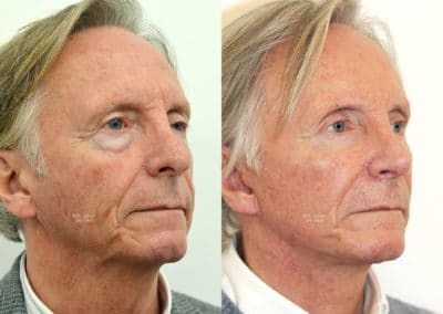 Facelift in London Before & After Results