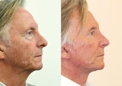 Facelift in London Before & After Results