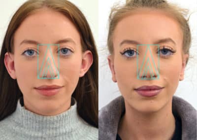 Rhinoplasty in London Before & After Results