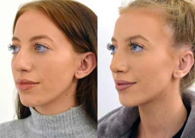 Rhinoplasty in London Before & After Results