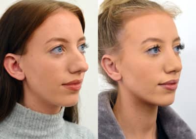 Rhinoplasty in London Before & After Results