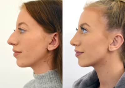 Rhinoplasty in London Before & After Results