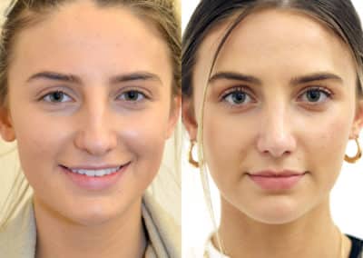 Rhinoplasty in London Before & After Results