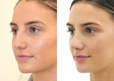 Rhinoplasty in London Before & After Results