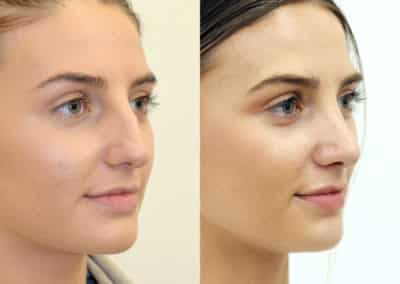 Rhinoplasty in London Before & After Results