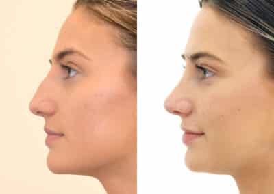 Rhinoplasty in London Before & After Results