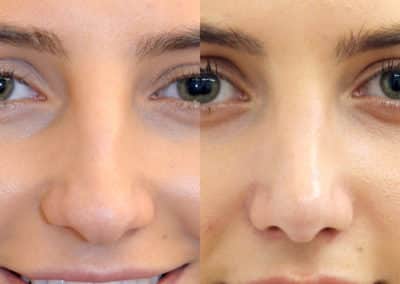 Rhinoplasty in London Before & After Results