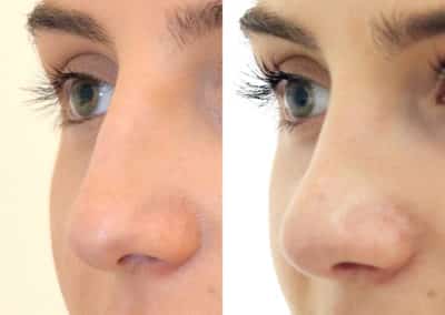 Rhinoplasty in London Before & After Results