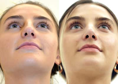 Rhinoplasty in London Before & After Results