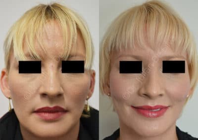 Rhinoplasty in London Before & After Results