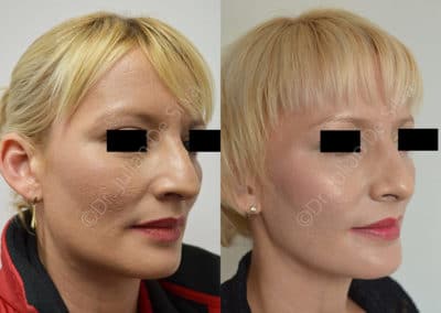 Rhinoplasty in London Before & After Results