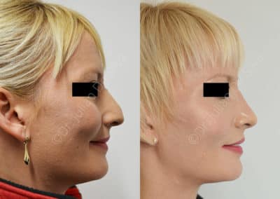 Rhinoplasty in London Before & After Results