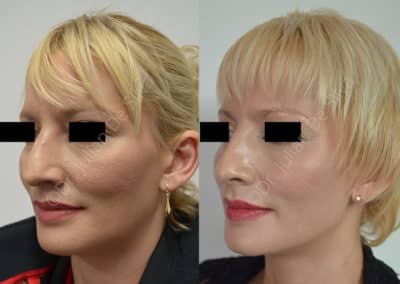 Rhinoplasty in London Before & After Results