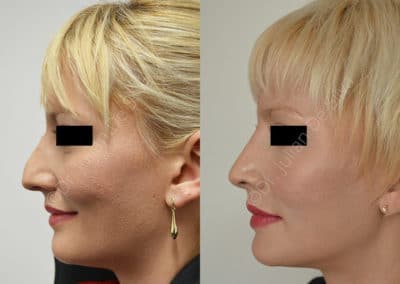 Rhinoplasty in London Before & After Results