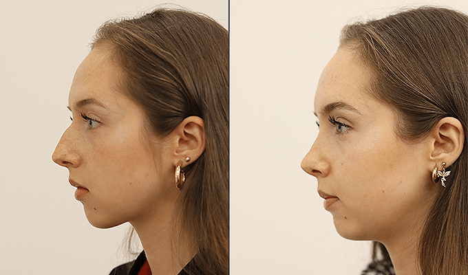 Rhinoplasty in London Before & After Results