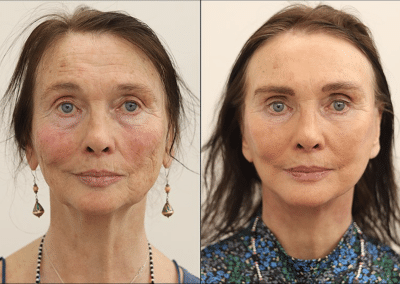 Facelift Surgery in London