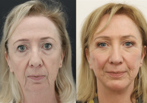 Facelift Surgery in London