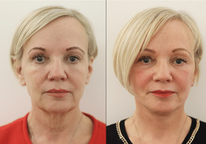 Facelift Surgery in London