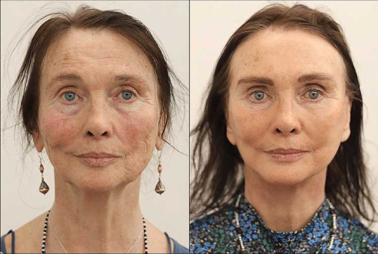 Facelift & Neck Lift Before & After Surgery in London