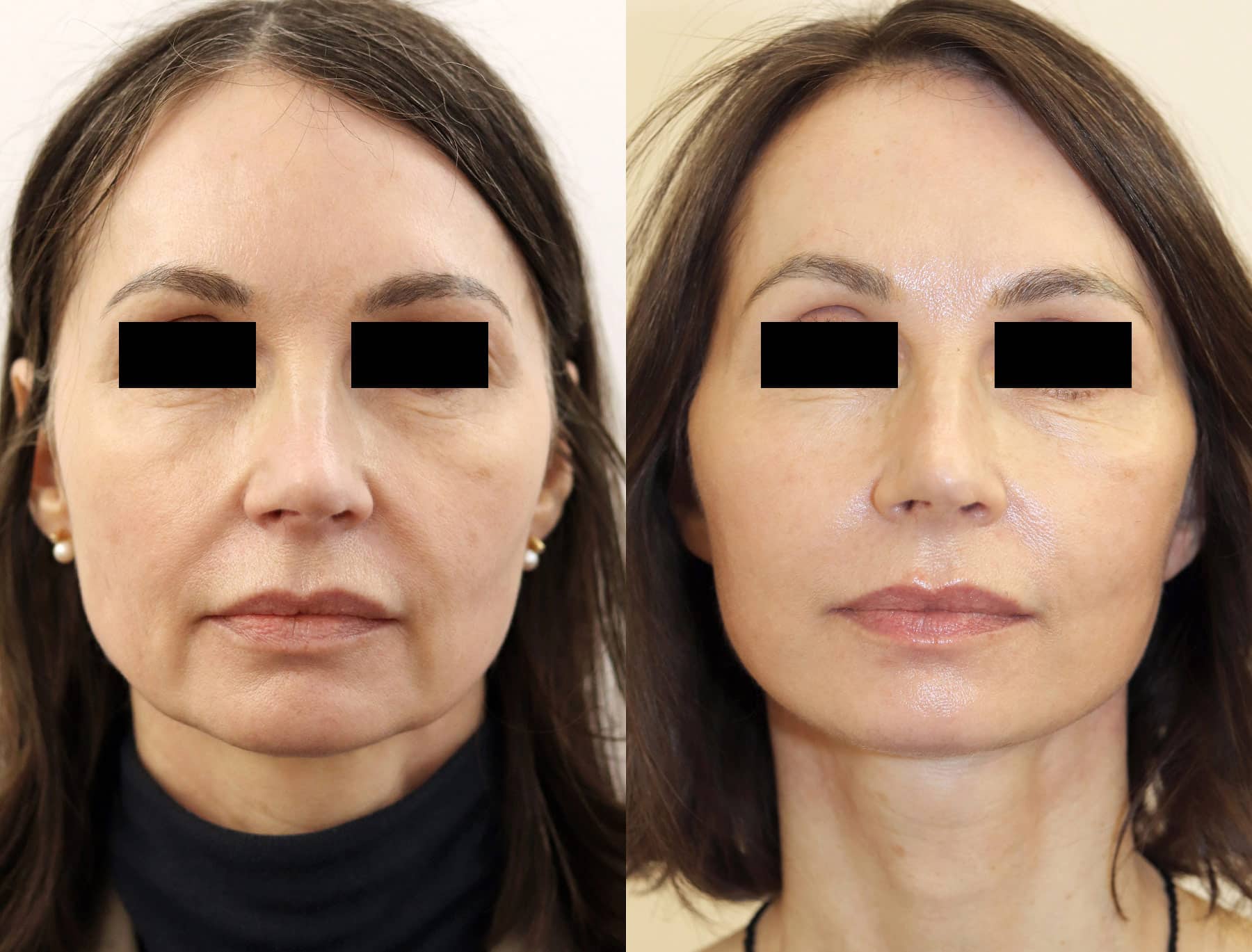 Facelift in London Before & After Results