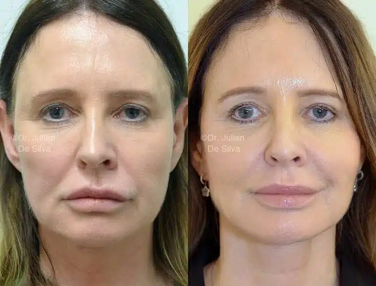 Facelift in London Before & After Results