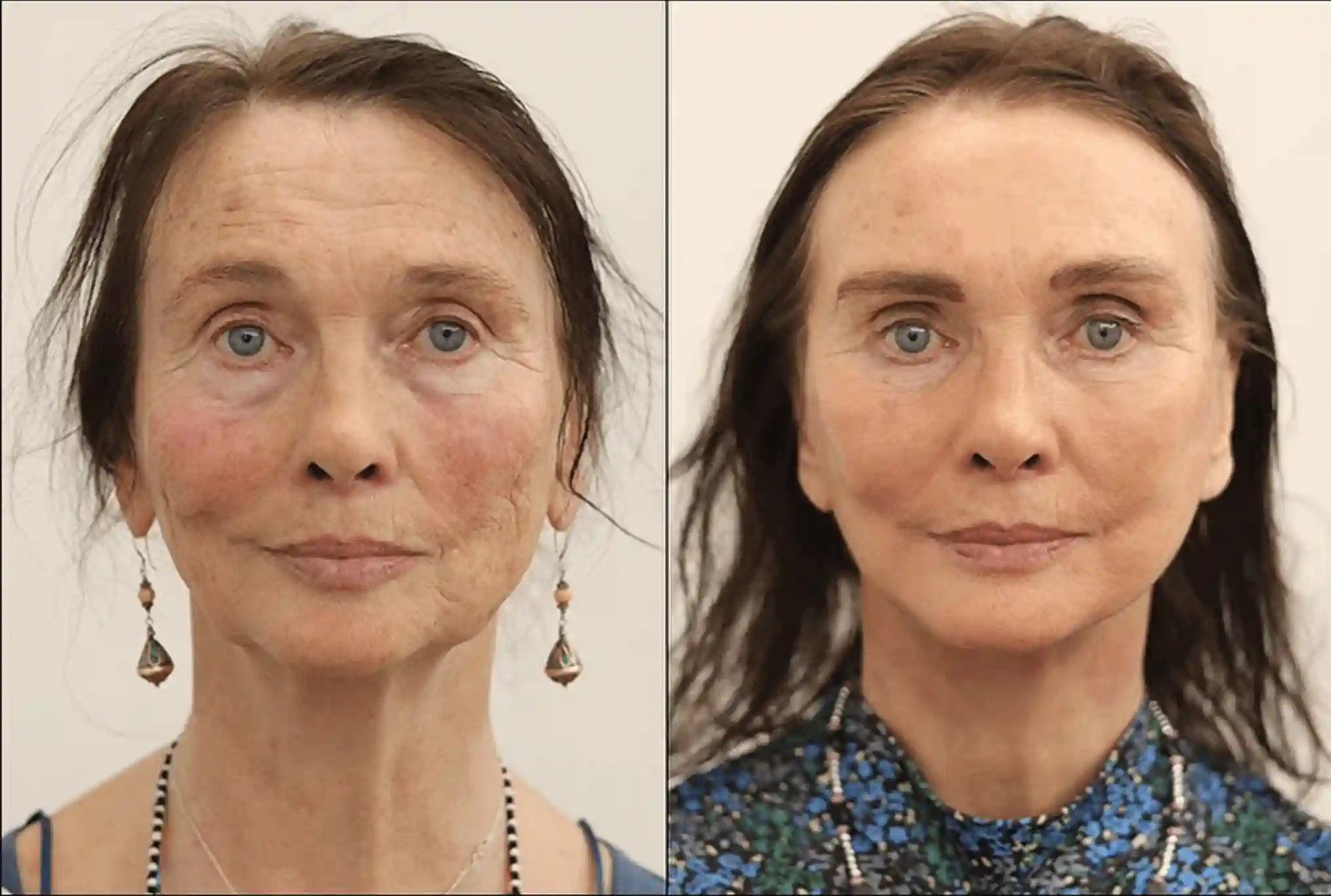 Facelift in London Before & After Results