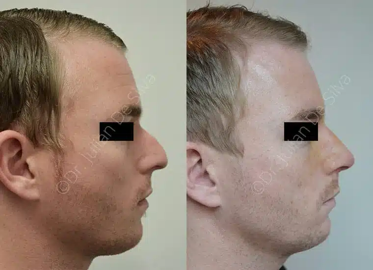 Rhinoplasty in London Before & After Results