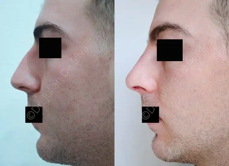 Rhinoplasty in London Before & After Results