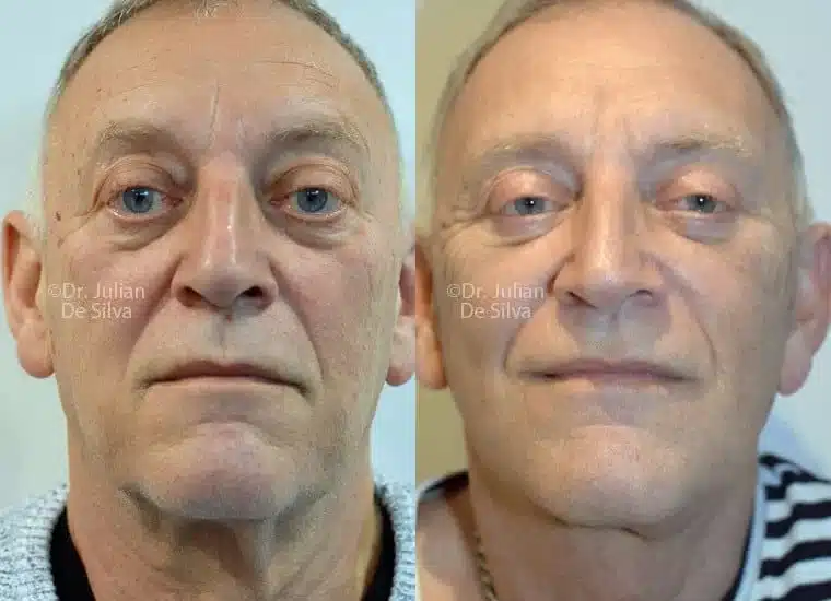 Facelift in London Before & After Results