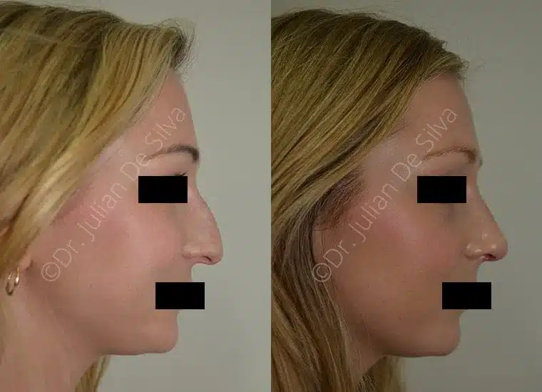 Rhinoplasty in London Before & After Results