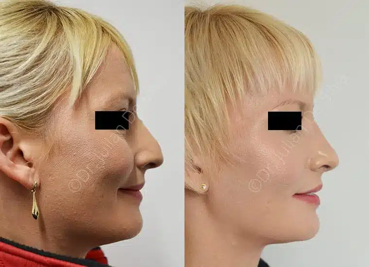 Rhinoplasty in London Before & After Results