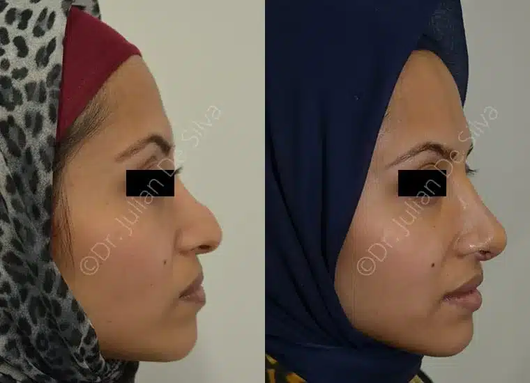 Rhinoplasty in London Before & After Results