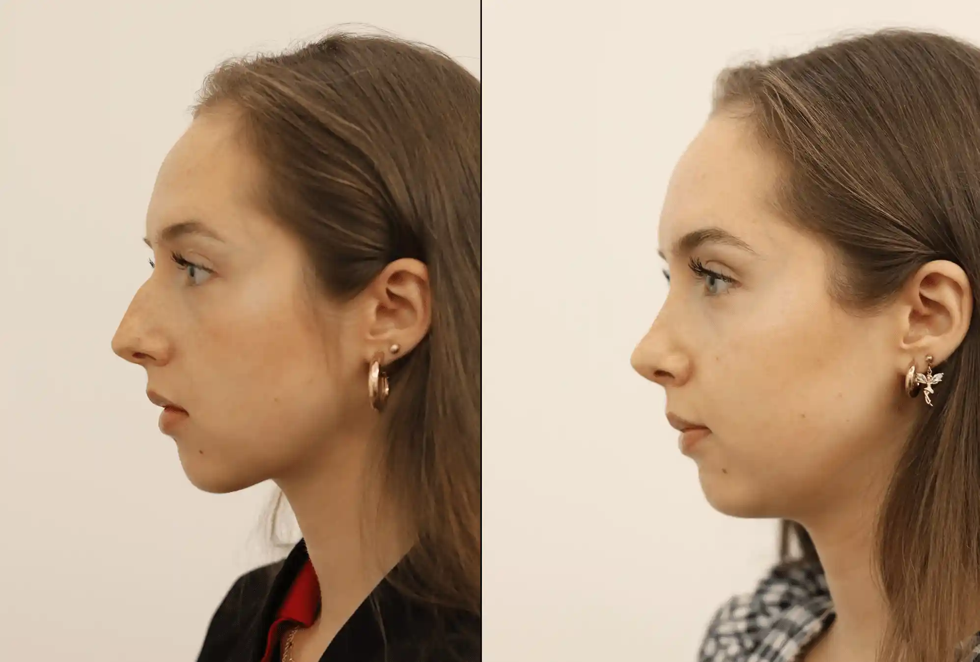 Rhinoplasty in London Before & After Results