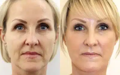 Behind the Scenes: Unveiling the Pain Factor in a Full Facelift