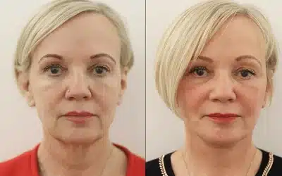 Clocking In: How Many Hours Does a Facelift Procedure Take?