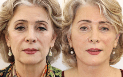 Recovery After a Facelift: Tips for a Smooth and Quick Healing Process