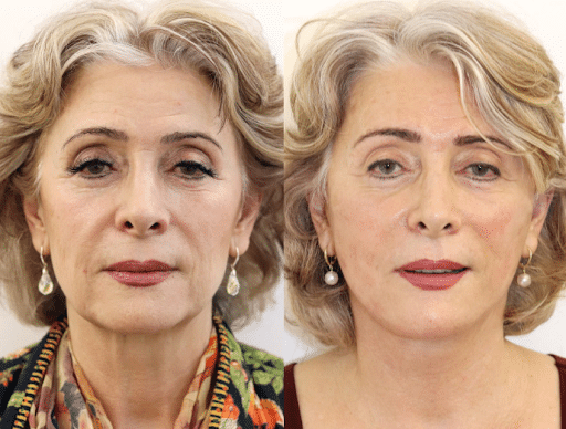 Recovery After a Facelift: Tips for a Smooth and Quick Healing Process